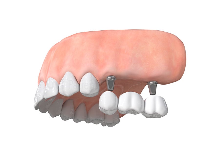 Implant Bridge in Roselle, IL