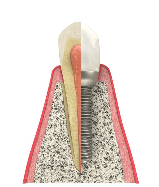 Benefits of Dental Implants